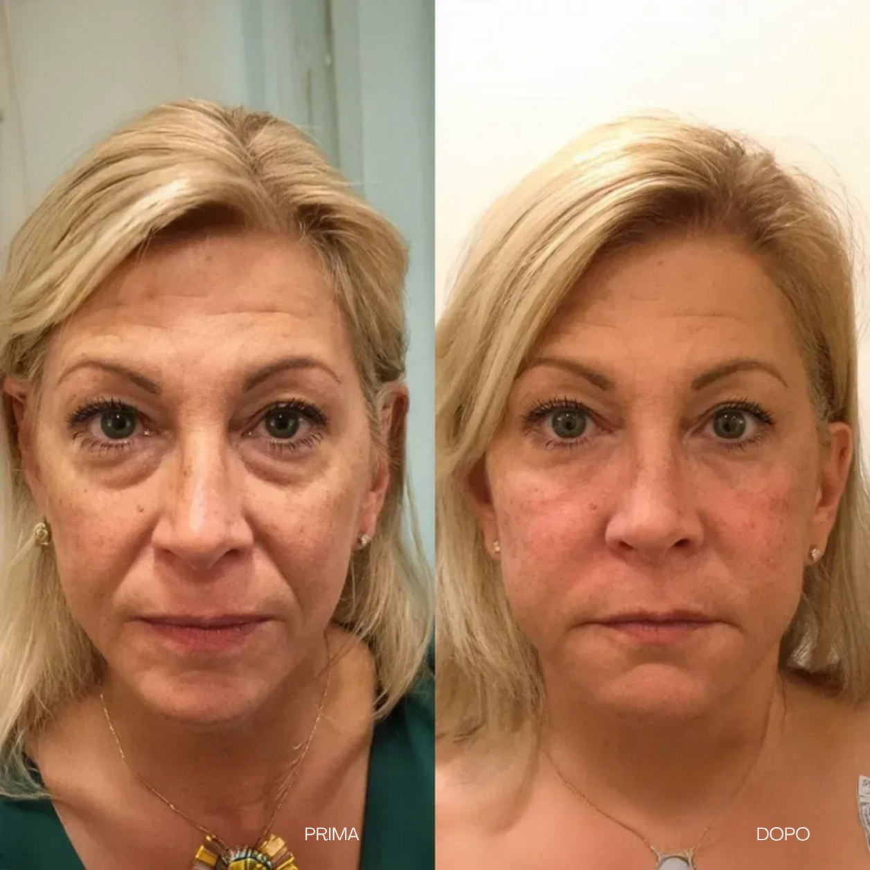 V-LIFT OCCHI