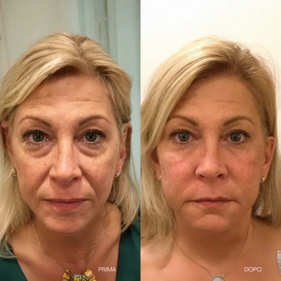 V-LIFT OCCHI